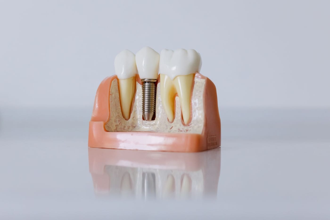 A cross-section model of a dental implant beside natural teeth